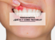 Periodontitis ¿Qué es y como tratarla?