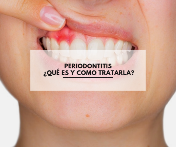 Periodontitis ¿Qué es y como tratarla?