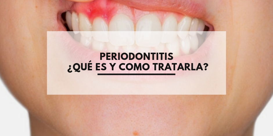 Periodontitis ¿Qué es y como tratarla?