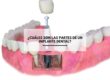 ¿Cuáles son las partes de un implante dental?