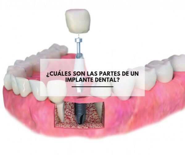 ¿Cuáles son las partes de un implante dental?