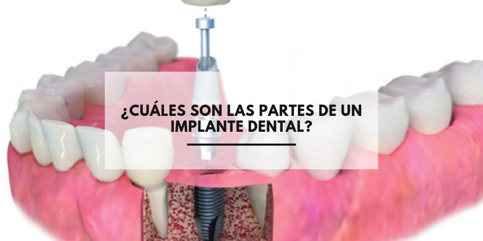 ¿Cuáles son las partes de un implante dental?