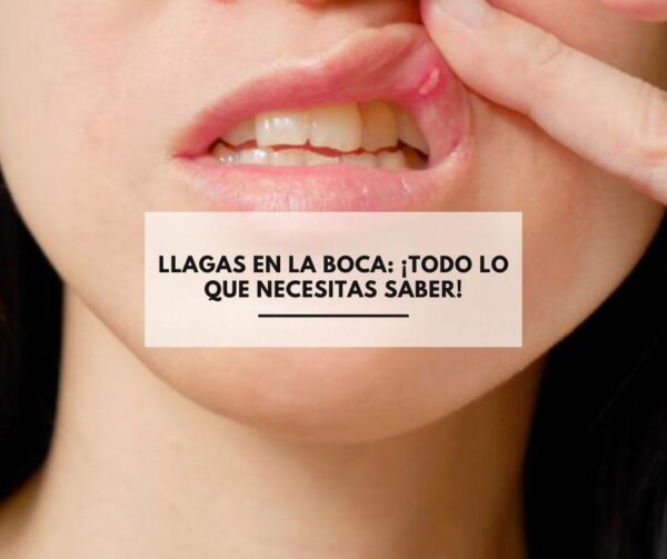 Llagas en la boca: ¡Todo lo que necesitas saber! Llagas en la boca: ¡Todo lo que necesitas saber!