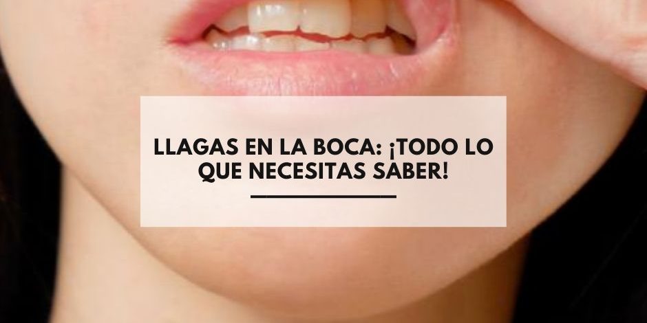 Llagas en la boca: ¡Todo lo que necesitas saber!