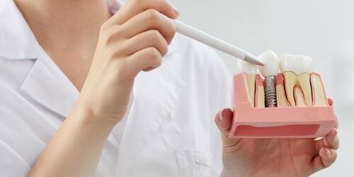 partes de un implante dental