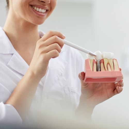 partes de un implante dental