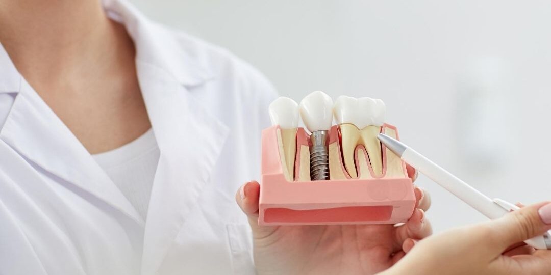 partes de un implante dental