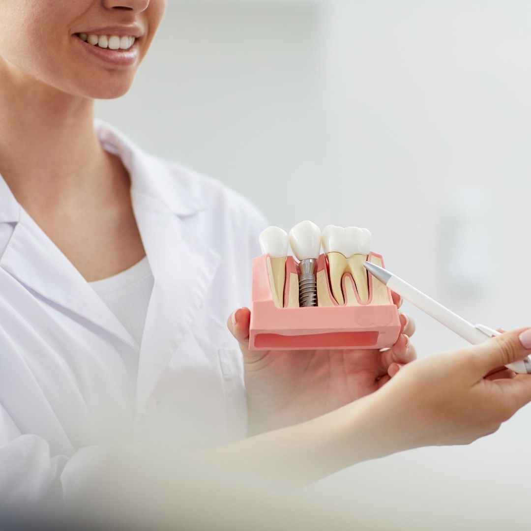 partes de un implante dental