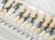 implantes dentales