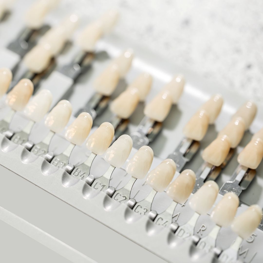 implantes dentales