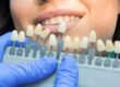 blanqueamiento dental