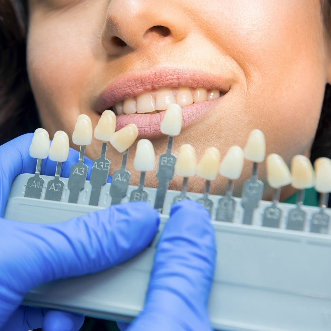 blanqueamiento dental