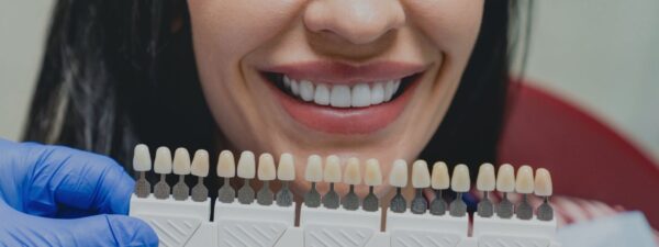 carillas de porcelana