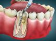 Ventajas de la endodoncia,