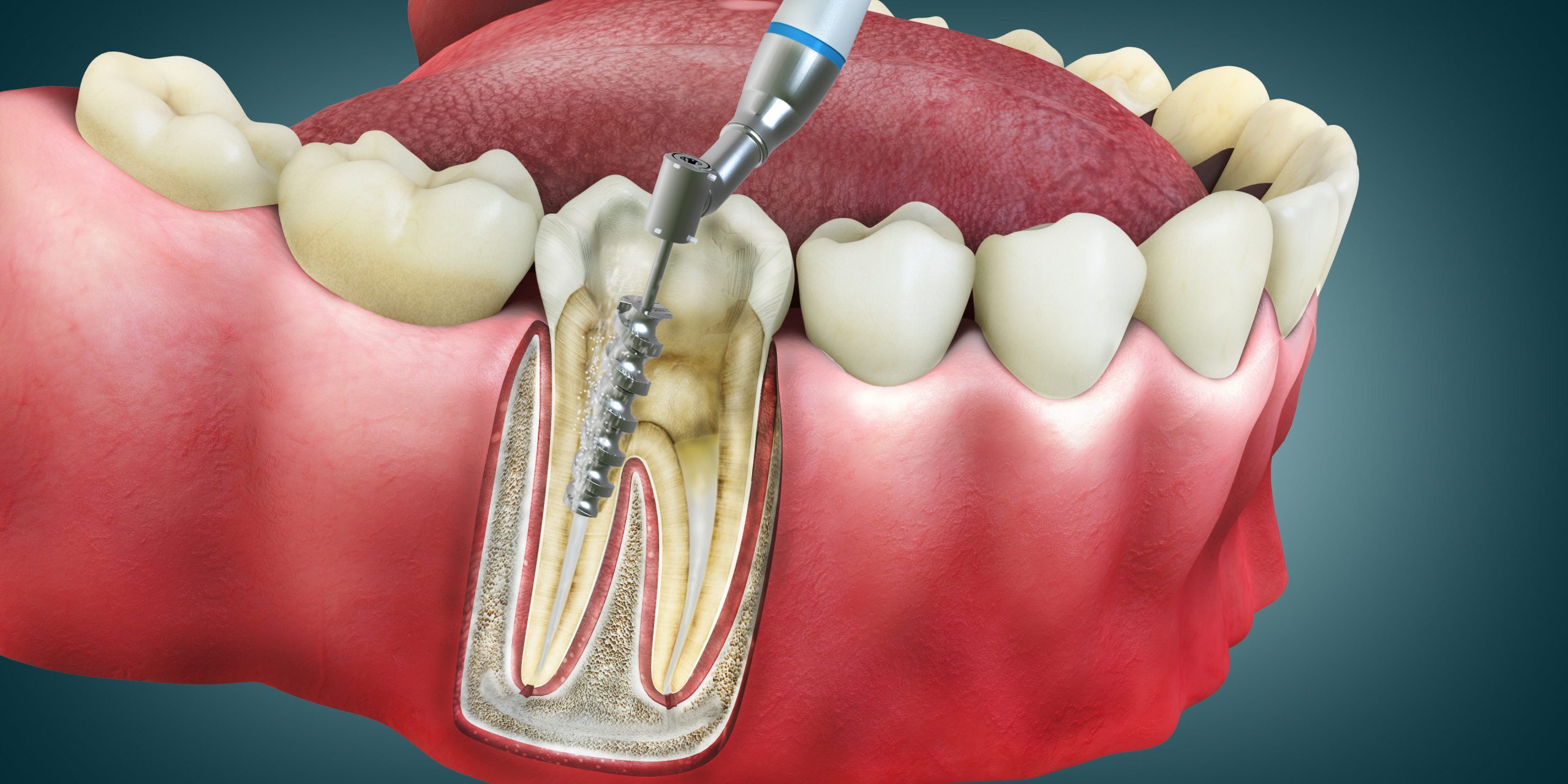 Ventajas de la endodoncia,