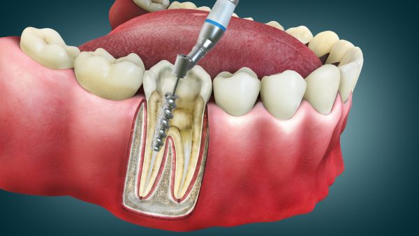 Ventajas de la endodoncia,