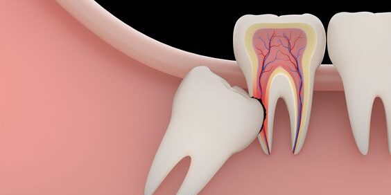 pericoronitis pericoronitis