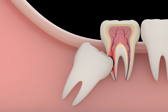 pericoronitis