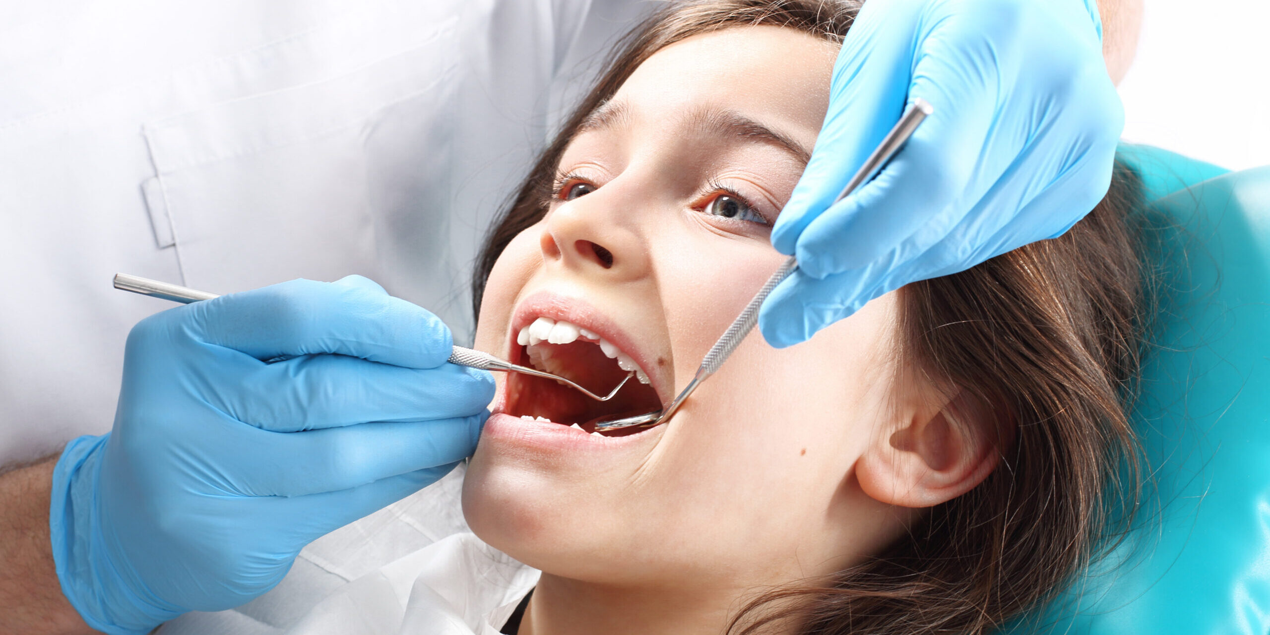 selladores dentales en niños