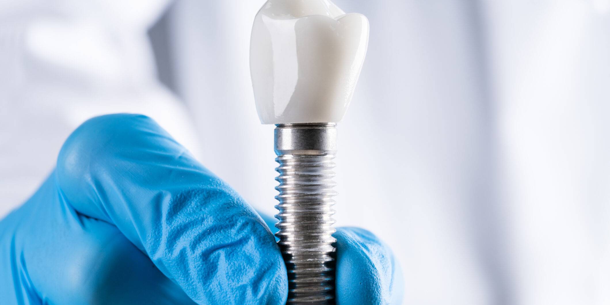 Implantes inmediatos vs. implantes diferidos