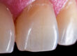 microfracturas dentales