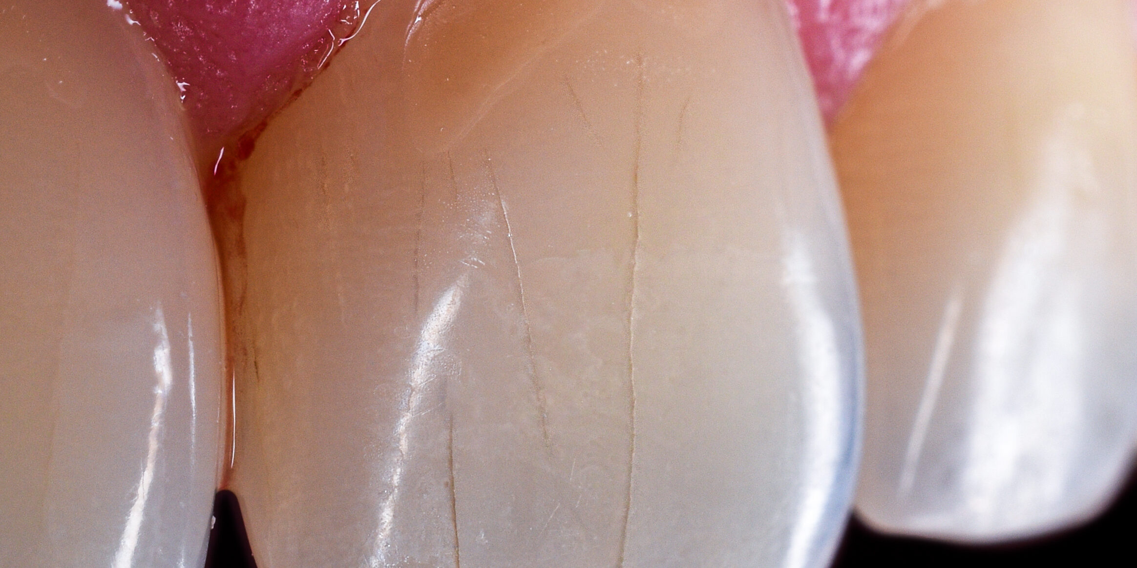 microfracturas dentales microfracturas dentales