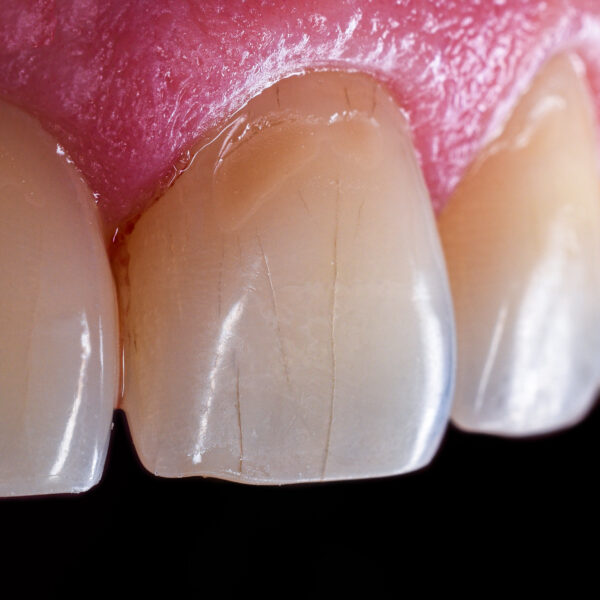 microfracturas dentales microfracturas dentales