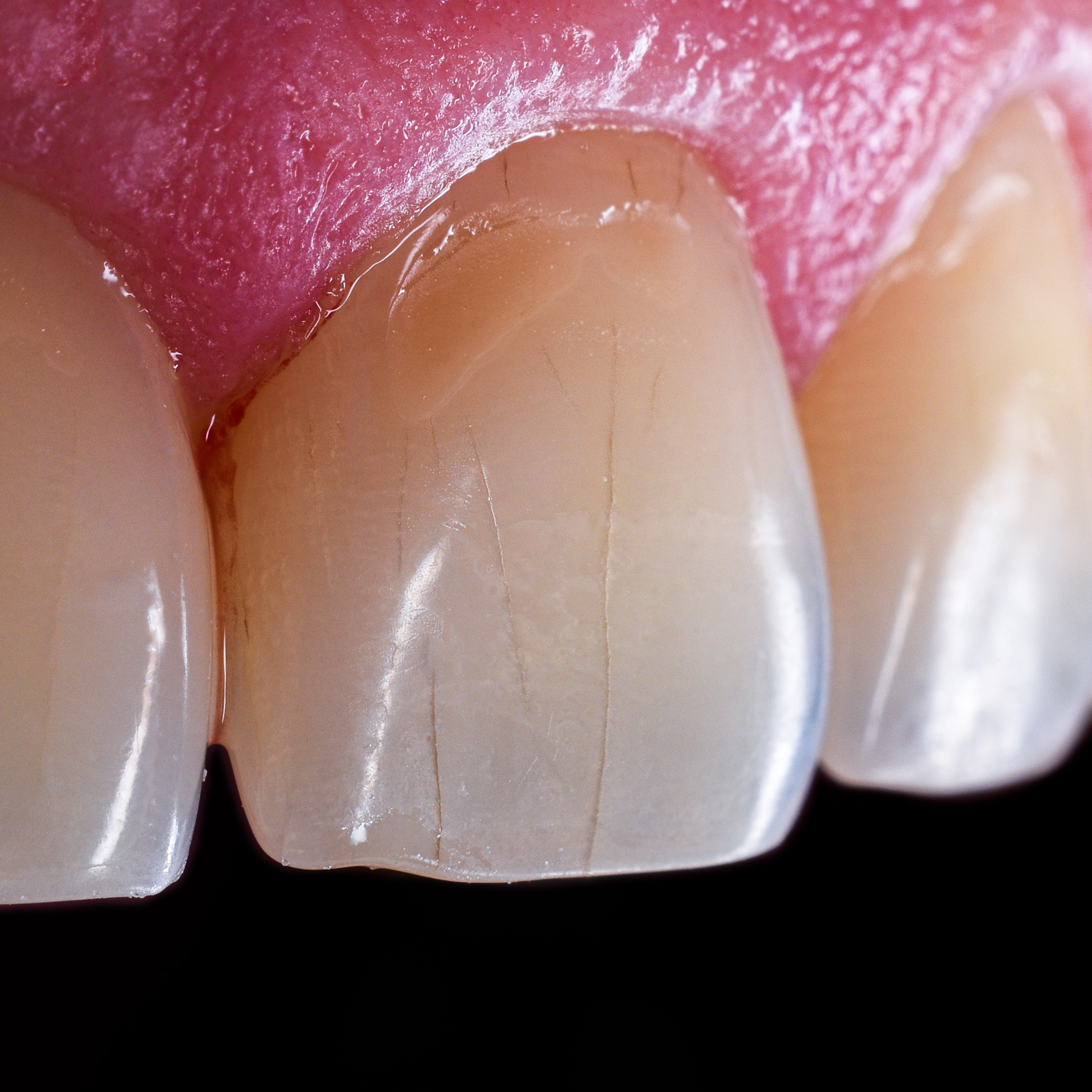 microfracturas dentales