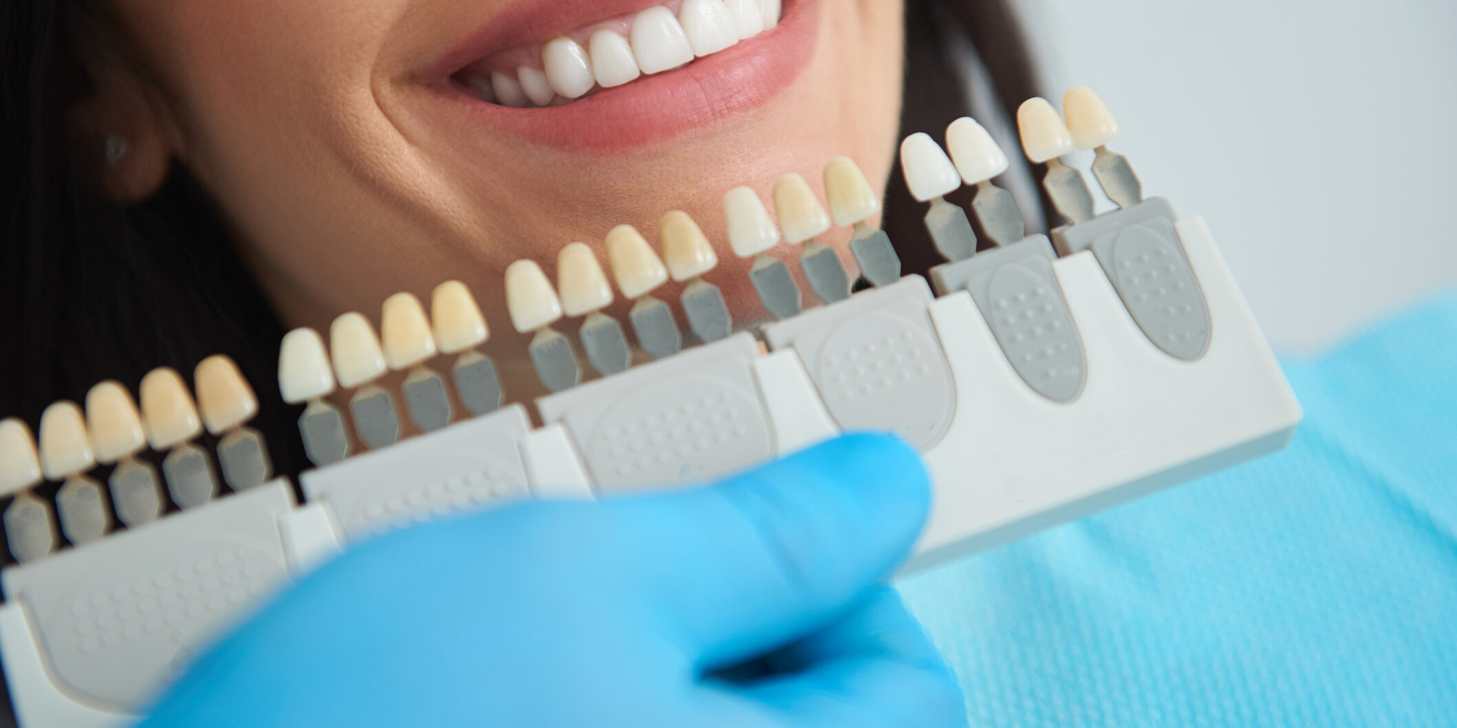 diagnóstico para carillas dentales diagnóstico para carillas dentales