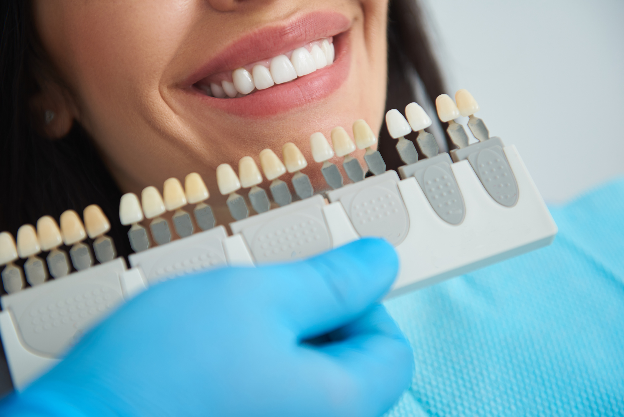 diagnóstico para carillas dentales diagnóstico para carillas dentales