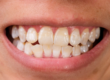 Hipoplasia del Esmalte