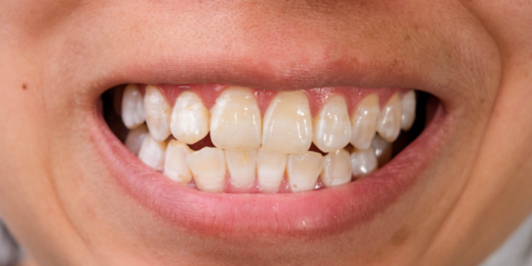 Hipoplasia del Esmalte