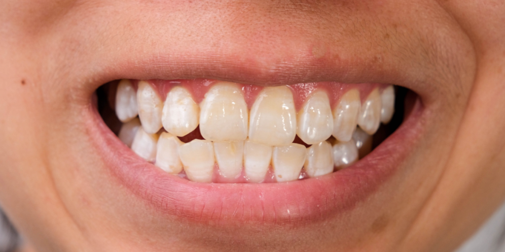 Hipoplasia del Esmalte