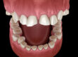 cómo tratar el desgaste dental
