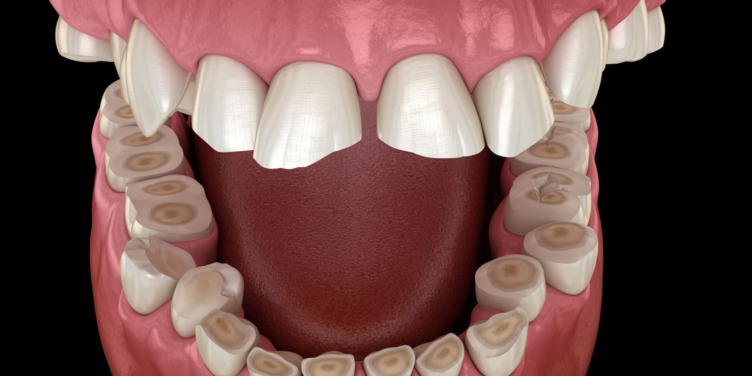 cómo tratar el desgaste dental