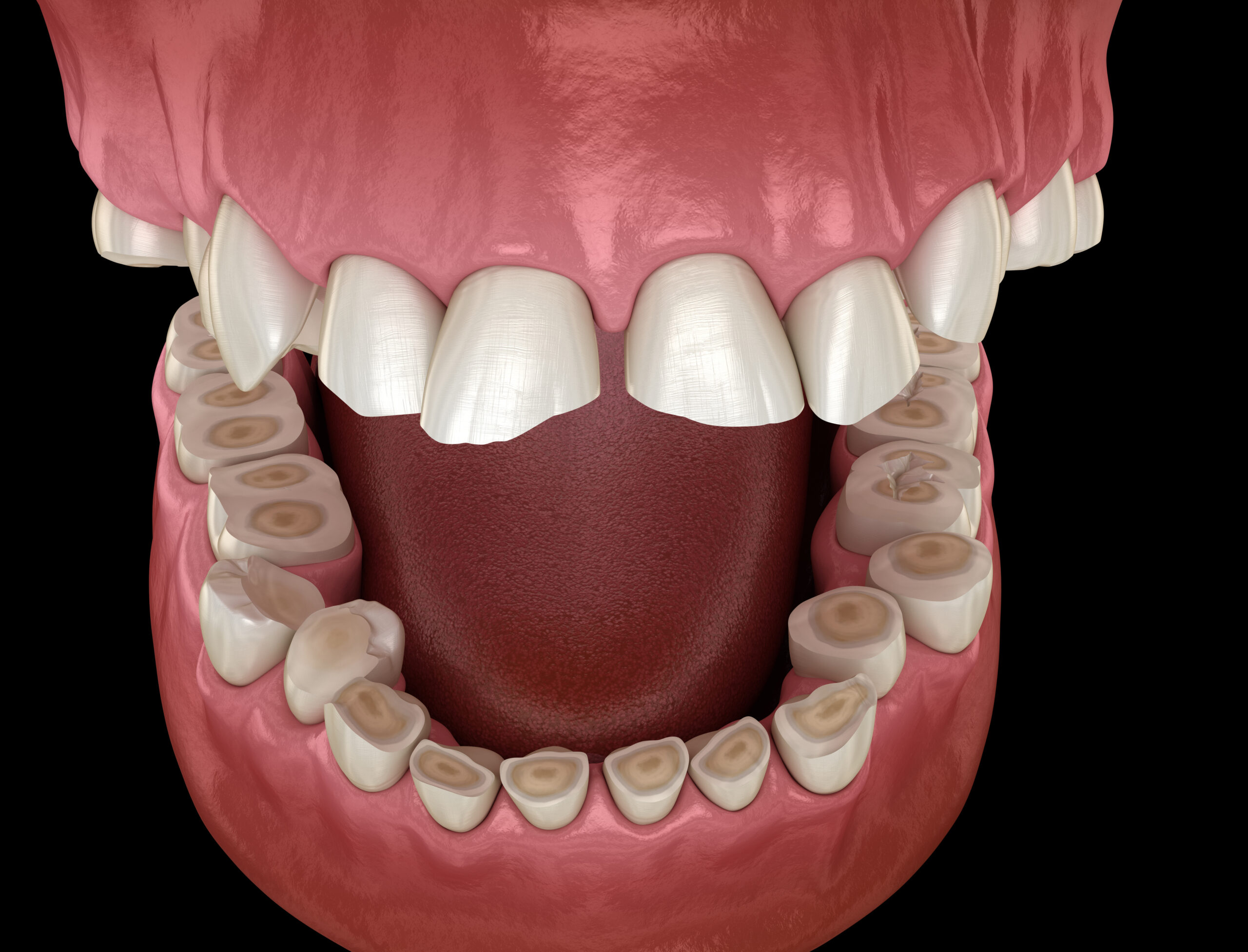 cómo tratar el desgaste dental cómo tratar el desgaste dental