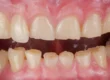 Desgaste dental sin caries