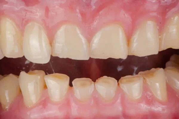 Desgaste dental sin caries