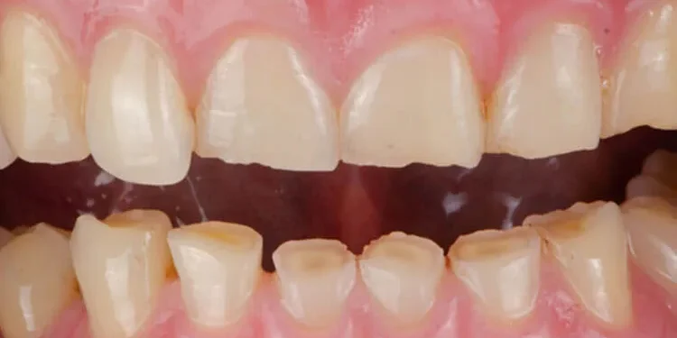 Desgaste dental sin caries